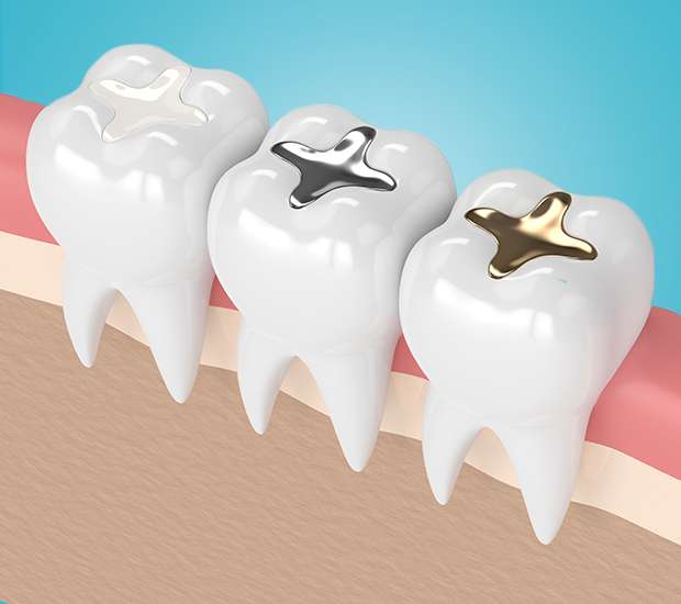 Syosset Composite Fillings