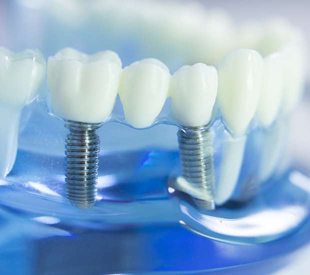 Syosset Dental Implants
