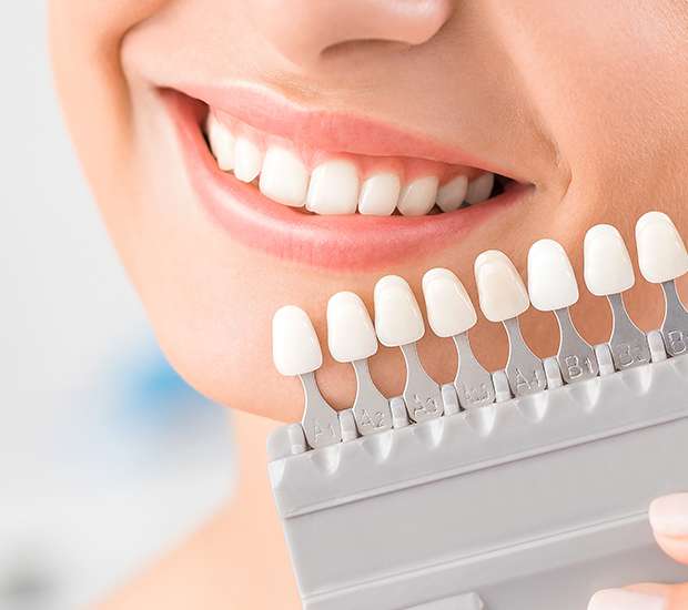 Syosset Dental Veneers and Dental Laminates